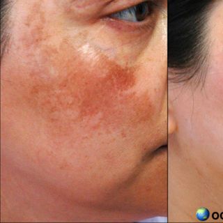 Kem Mediquin Kem Hydroquinone 5 Trị Thâm Nám Tàn Nhang Gốc Sâu