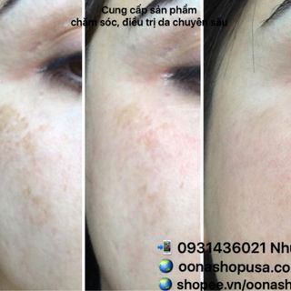 Kem Mediquin Kem Hydroquinone 5 Trị Thâm Nám Tàn Nhang Gốc Sâu