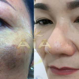 KEM TRỊ NÁM - TÀN NHANG - THÂM QUẨNG MẮT AIA 20G MỸ PHẨM AIA