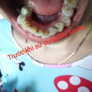 Trắng răng than hoạt tính My Smile