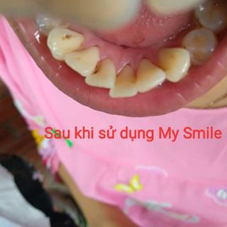 Trắng răng than hoạt tính My Smile