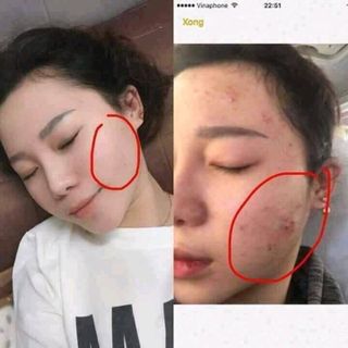 Bạch Đan Dược Serum Trị thâm mụn nám