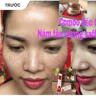 Kem đặc trị nám