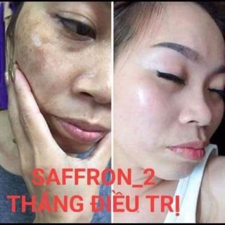 Kem đặc trị nám