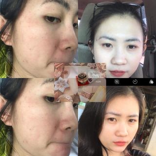 Kem đặc trị nám
