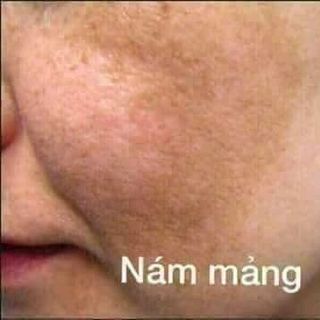 bộ mỹ phẩm dưỡng trắng da trị mụn nám cao cấp