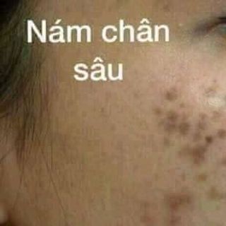 bộ mỹ phẩm dưỡng trắng da trị mụn nám cao cấp