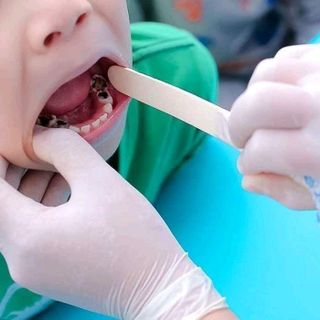 trị sâu răng mẹ tấm-Thanh mộc hương
