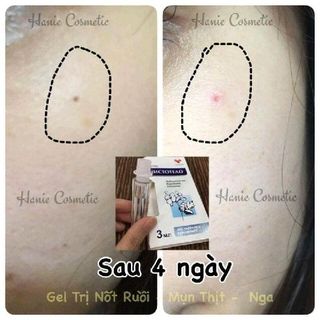 trị mụn cóc
