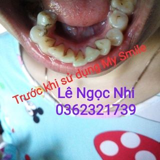 My Smile trắng răng than hoạt tính