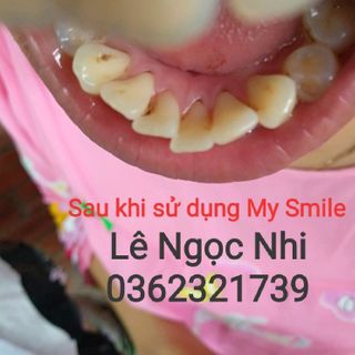 My Smile trắng răng than hoạt tính