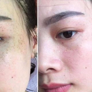 kem trị nám H2