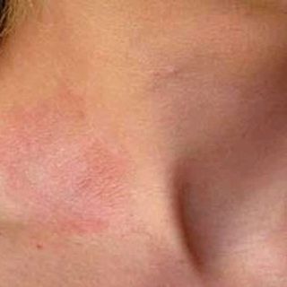 cao Ayofa chữa bệnh ngoài da