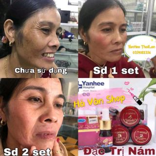Bộ Đặc Trị Nám YanHee ThaiLan