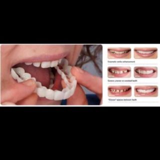 Dụng cụ nẹp răng snapon smile