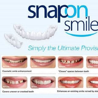 Dụng cụ nẹp răng snapon smile