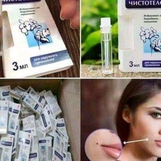 tẩy nốt ruồi