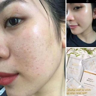 MẶT NẠ TẾ BÀO GỐC NHAU THAI CỪU