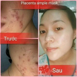 MẶT NẠ TẾ BÀO GỐC NHAU THAI CỪU