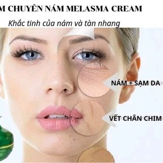 Kem Chuyên Nám Huỳnh Đỗ