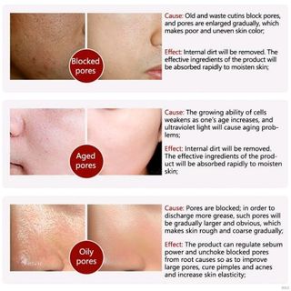 Serum LANBENA giúp thu nhỏ lỗ chân lông và làm sạch mụn đầu đen hiệu quả