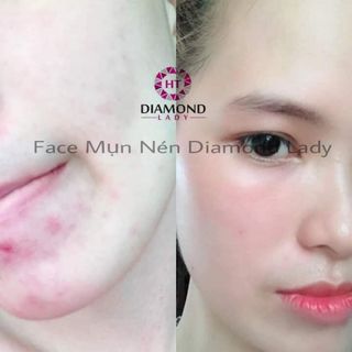 Kem Lottion trị mụn Diamond Lady