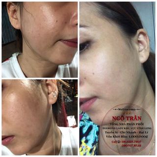 Kem Lottion trị mụn Diamond Lady