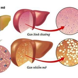 Thải Độc Gan An Nhiên Ẩm - Bệnh Gout men gan mỡ máu huyết áp cao đại tràng