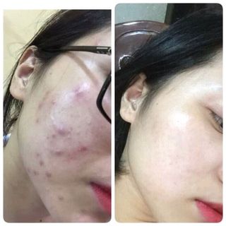 thải độc trị mụn