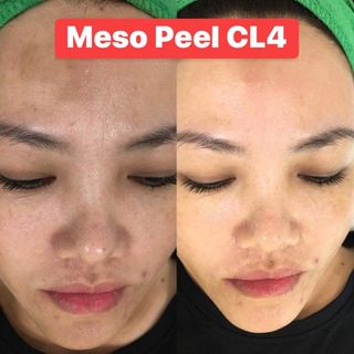 peel thảo dược meso peel cl4 làm trắng da trị mụn điều tiết đầu se khít lổ chân lông