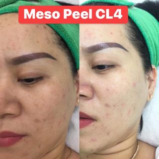 peel thảo dược meso peel cl4 làm trắng da trị mụn điều tiết đầu se khít lổ chân lông