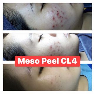 peel thảo dược meso peel cl4 làm trắng da trị mụn điều tiết đầu se khít lổ chân lông