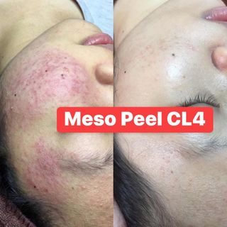 peel thảo dược meso peel cl4 làm trắng da trị mụn điều tiết đầu se khít lổ chân lông