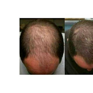 TINH DẦU BƯỞI LÀM MỀM MƯỢT TÓC KÍCH THÍCH MỌC TÓC TẶNG KÈM CHAI XỊT