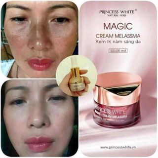 KEM ĐẶC TRỊ NÁM TÀNG NHANG MAGIC DƯỠNG TRẮNG DA MẶT