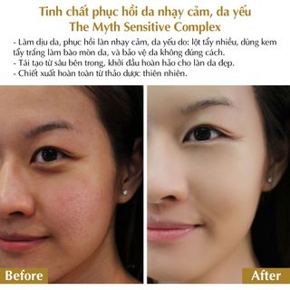 The Myth - Sensitive Complex Da Khô Da Viêm Nhạy Cảm