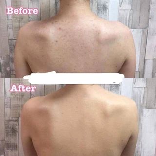 xà phòng trị mụn thái lan