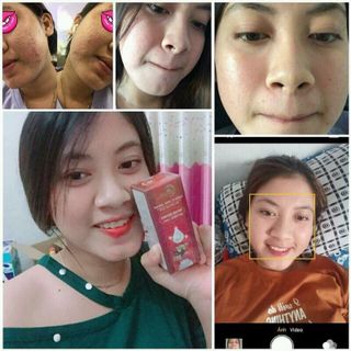 Serum Chuyên Trị Mụn Nám 100 - Mỹ Phẩm Thiên Nhiên Thanh Trang