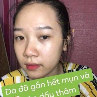 Mai thảo mộc trị mụn giá sỉ