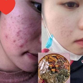 CAO TRỊ MỤN ĐÔNG Y NGỌC THIÊN HƯƠNG