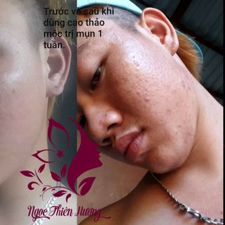 CAO TRỊ MỤN ĐÔNG Y NGỌC THIÊN HƯƠNG