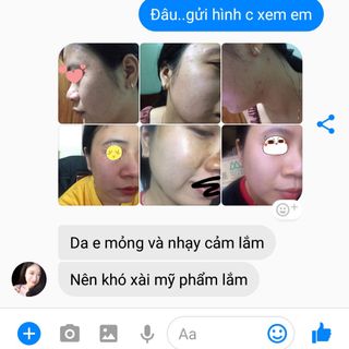 CAO TRỊ MỤN ĐÔNG Y NGỌC THIÊN HƯƠNG