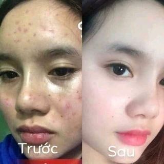 Combo Kem Konethái lan