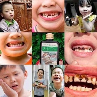Trị sâu răng mẹ Tấm