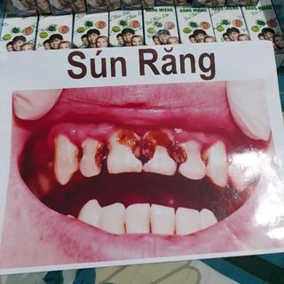 Tinh Dầu đặc trị viêm họng viêm Amidam