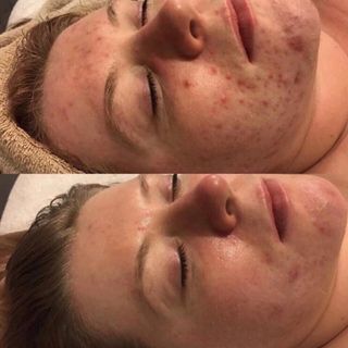 Sản Xuất Gia Công Peel AHA Peel BHA