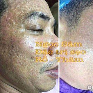 Kem Trị Mụn Không Sưng Đỏ Garnet