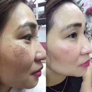 Bộ kem đặc trị mụn YanHee