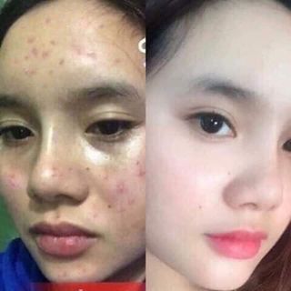 Bộ kem đặc trị mụn YanHee