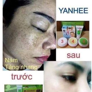 Bộ kem đặc trị mụn YanHee